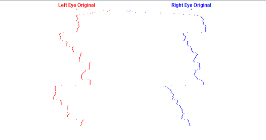 The patient wears a pair of glasses with infrared sensor to monitor eye tracking as the patient reads a story.  The device graphs the patient’s saccades and pursuits while measuring how often they re-read a word or skip a line.