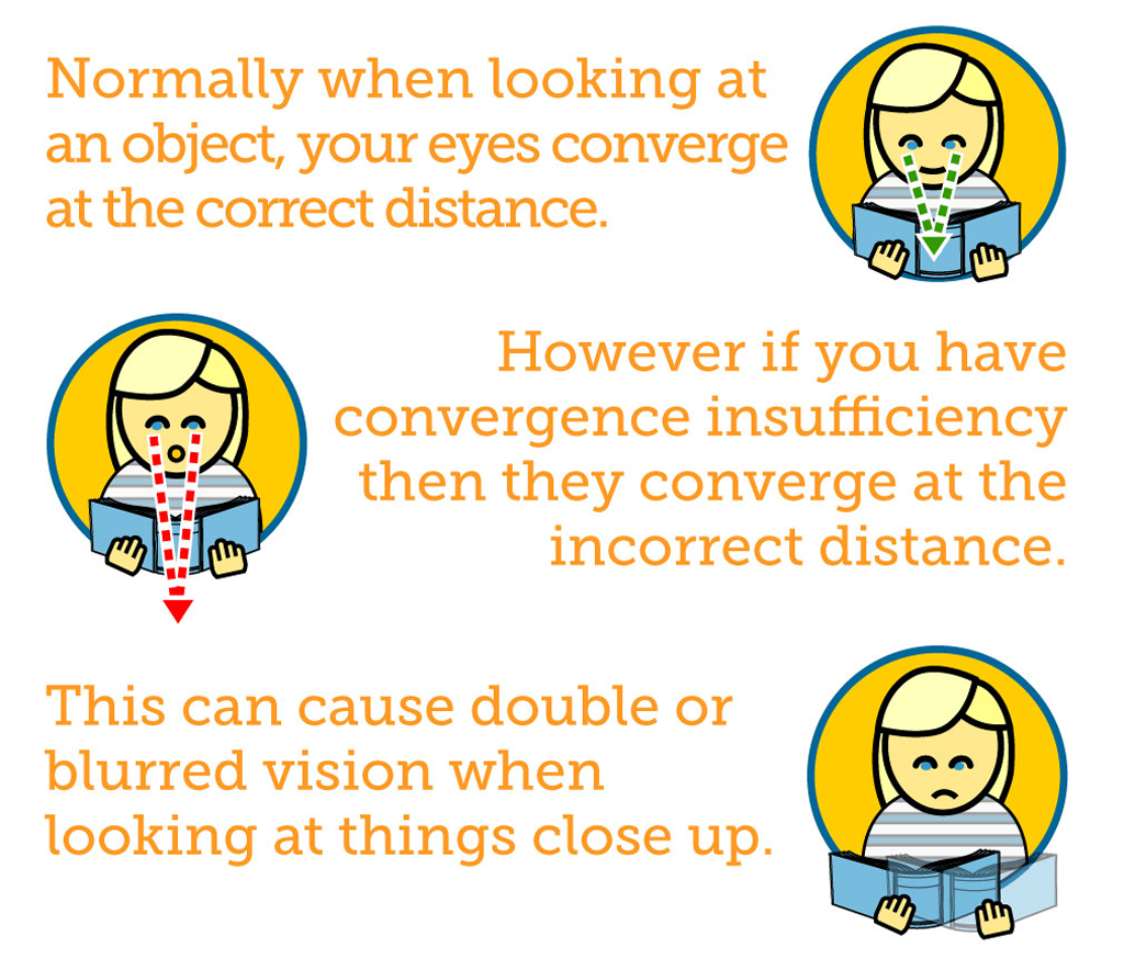 What Is Convergence Insufficiency What Is Convergence Insufficiency