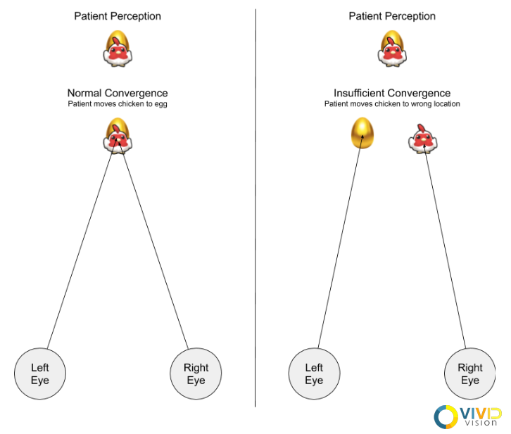 Example of two eyes converging on the chicken (shown only the right right eye) and the egg (shown only to the left eye). In the left, the patient has normal convergence and places the chicken in the same place in the world as the egg. In the right, the patient cannot converge far enough, and although they perceive the chicken to be lined up with the egg, they are separated in the world.