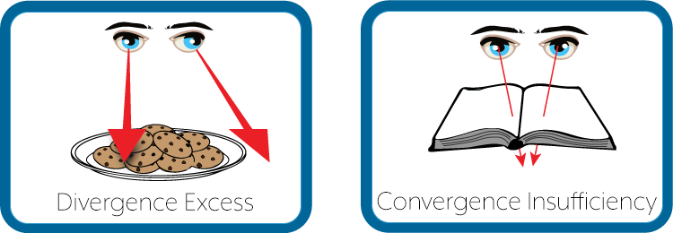 Convergence Insufficiency and Divergence Excess Eyes Graphic