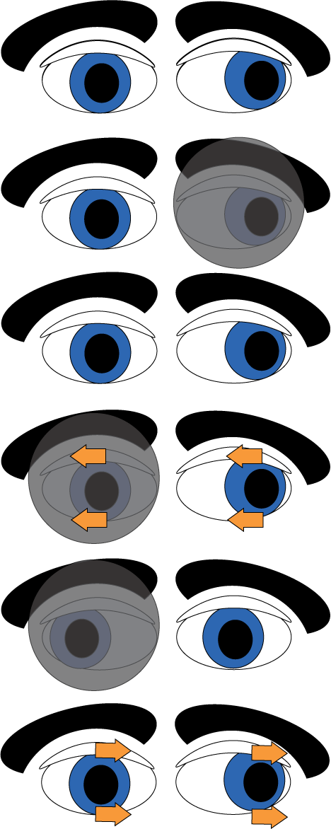 Exotropia