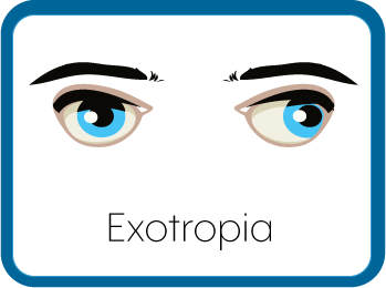 Exotropic Eyes Graphic