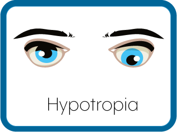Hypotropia Eyes Graphic