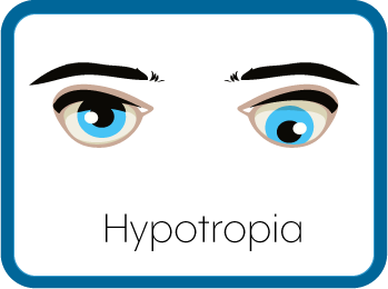 Hypotropic Eyes Graphic