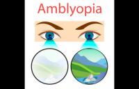 Amblyopia image - lazy eye amblyopia