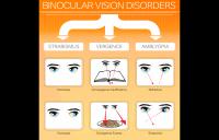 Binocular Vision Disorders Infographic - amblyopia strabismus vergence disorders exotropia divergence excess strabismic refractive esotropia exotropia high resolution