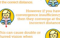 Convergence Insufficiency Description Graphic - convergence insufficiency amblyopia strabismus vergence disorders exotropia divergence excess strabismic refractive esotropia exotropia high resolution