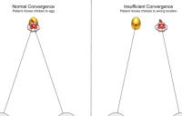 Convergence insufficiency measurement during Barnyard Bounce game - convergence insufficiency ci barnyard bounce