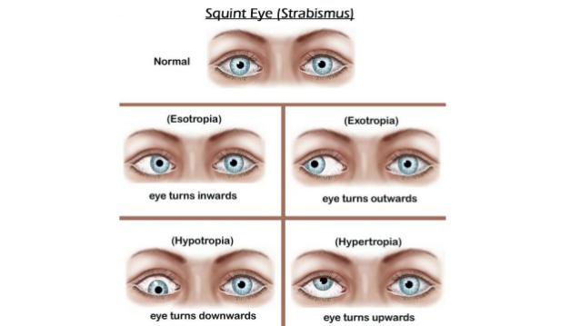 types of strabismus